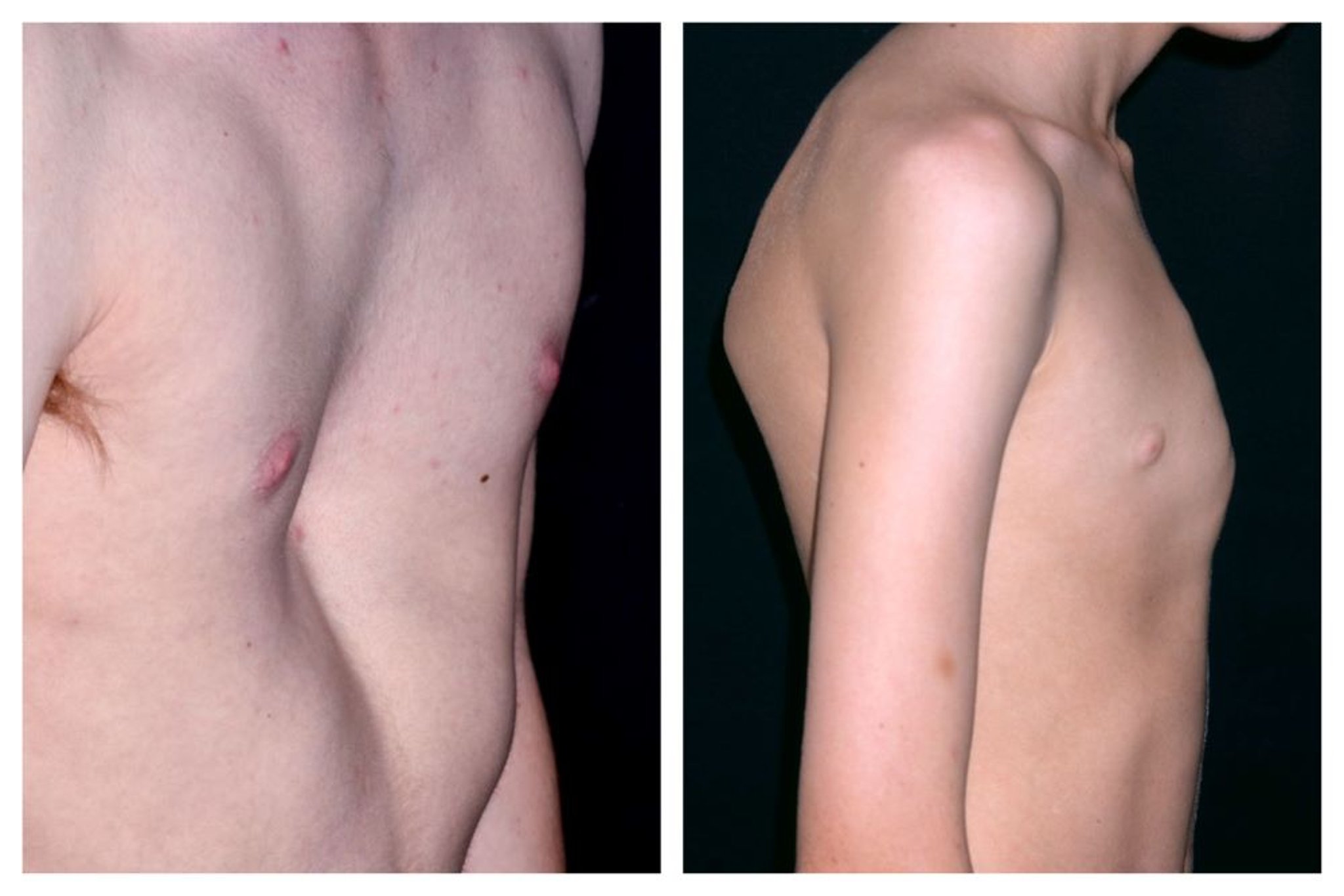 Pectus excavatum e pectus carinatum