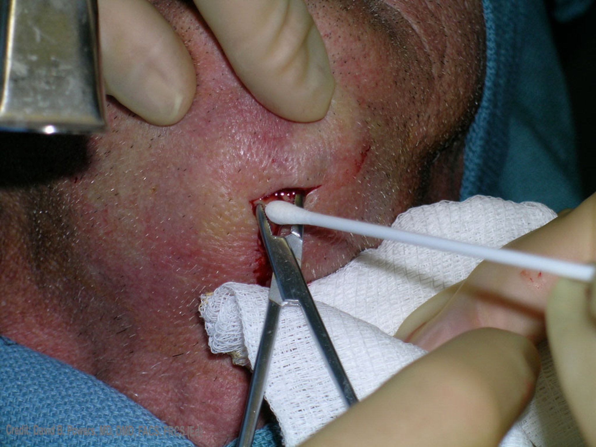 Placement of Hemostats