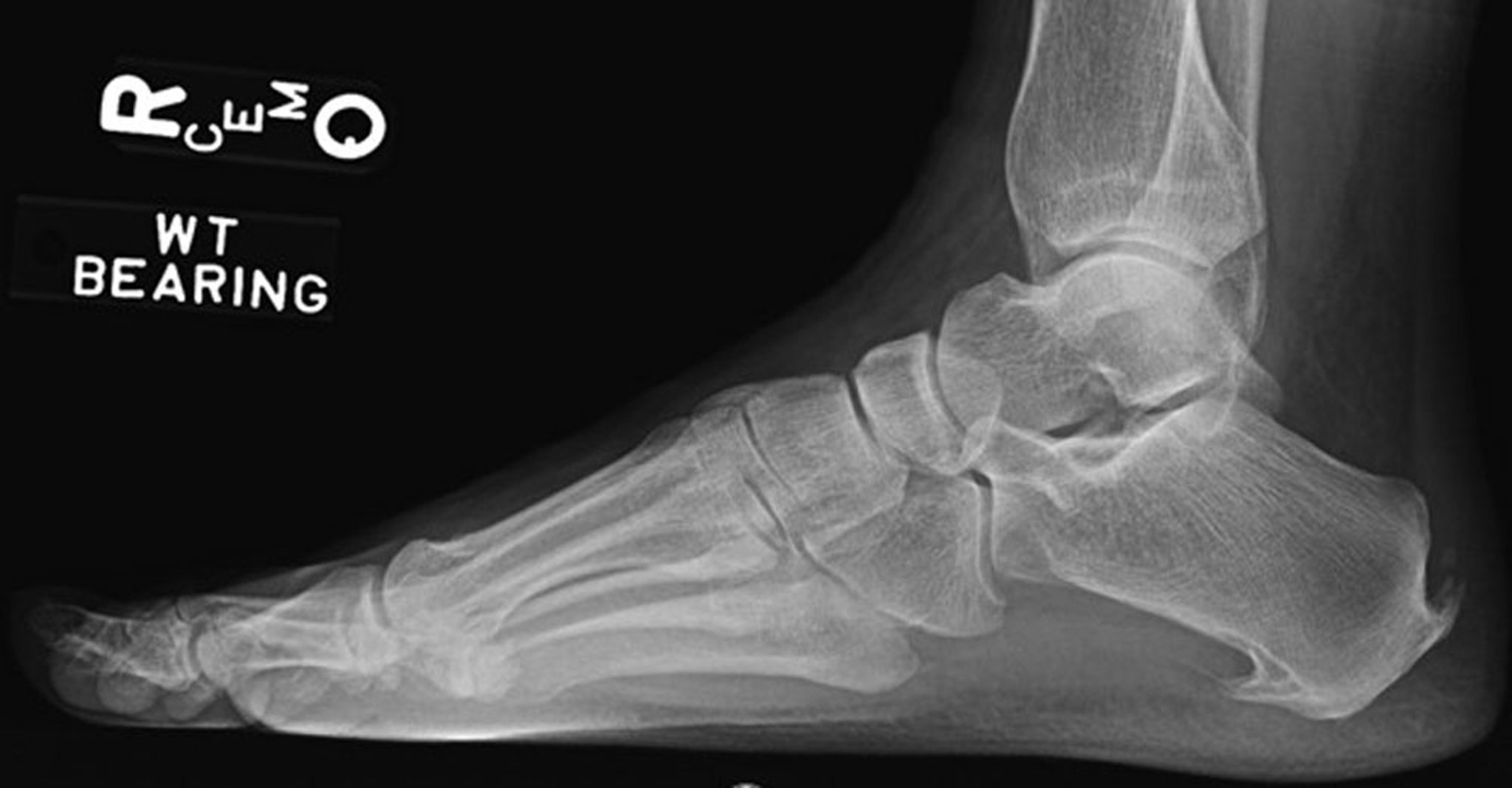 Combined Plantar and Calcaneal Spur
