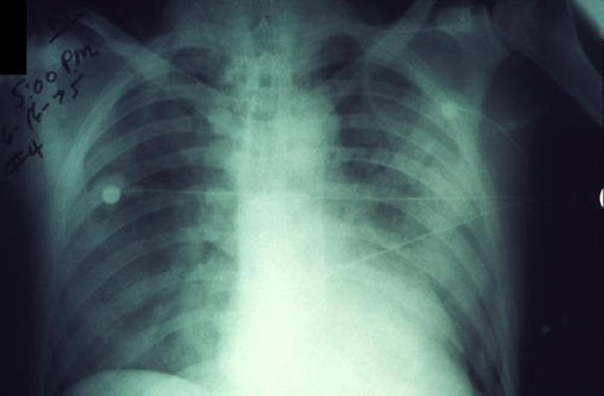 Легочная чума