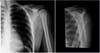 Hintere Schulterluxation: Anteroposteriore und Y-Ansicht