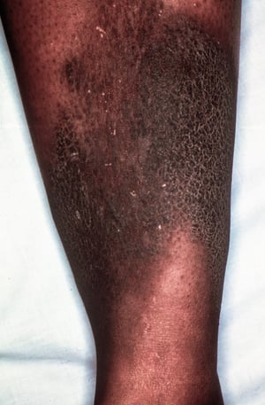 Mixedema pretibial