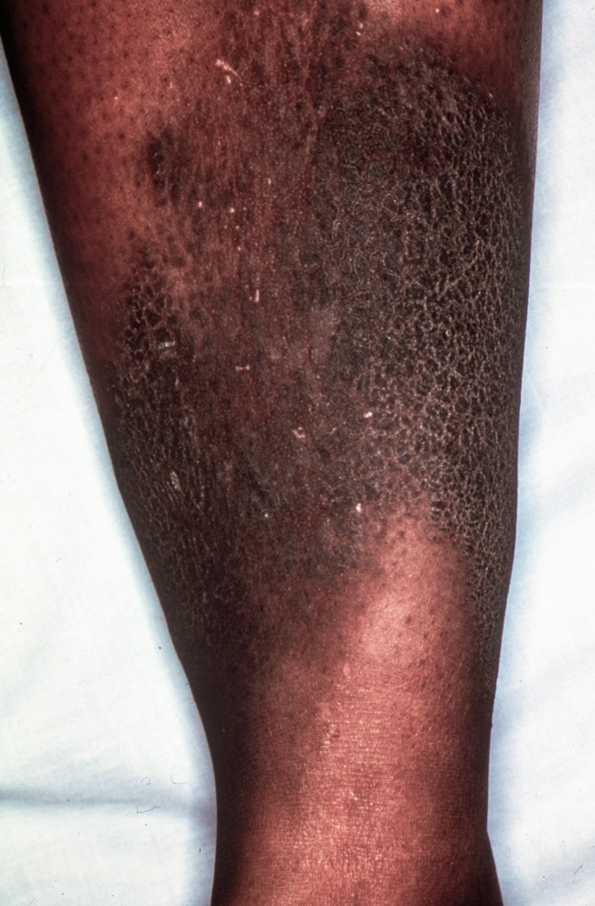 Myxœdème prétibial