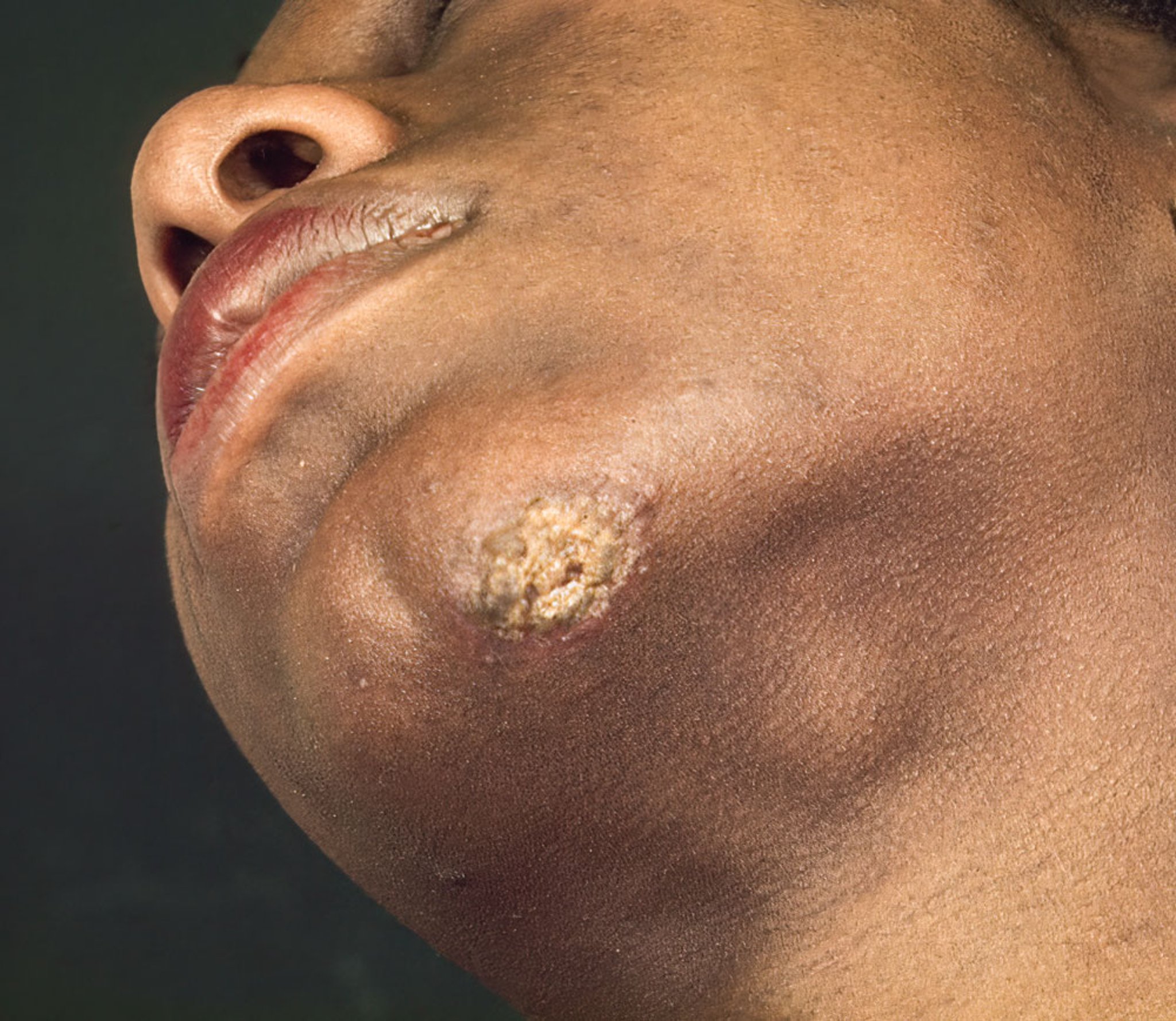 Syphilis primaire (chancre extragénital)