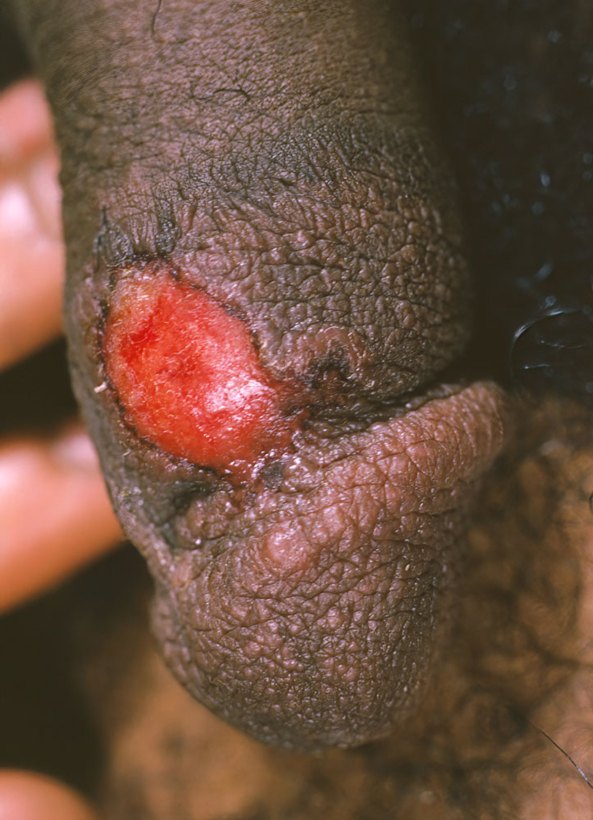 Primary Syphilis (Genital Chancre) (2)