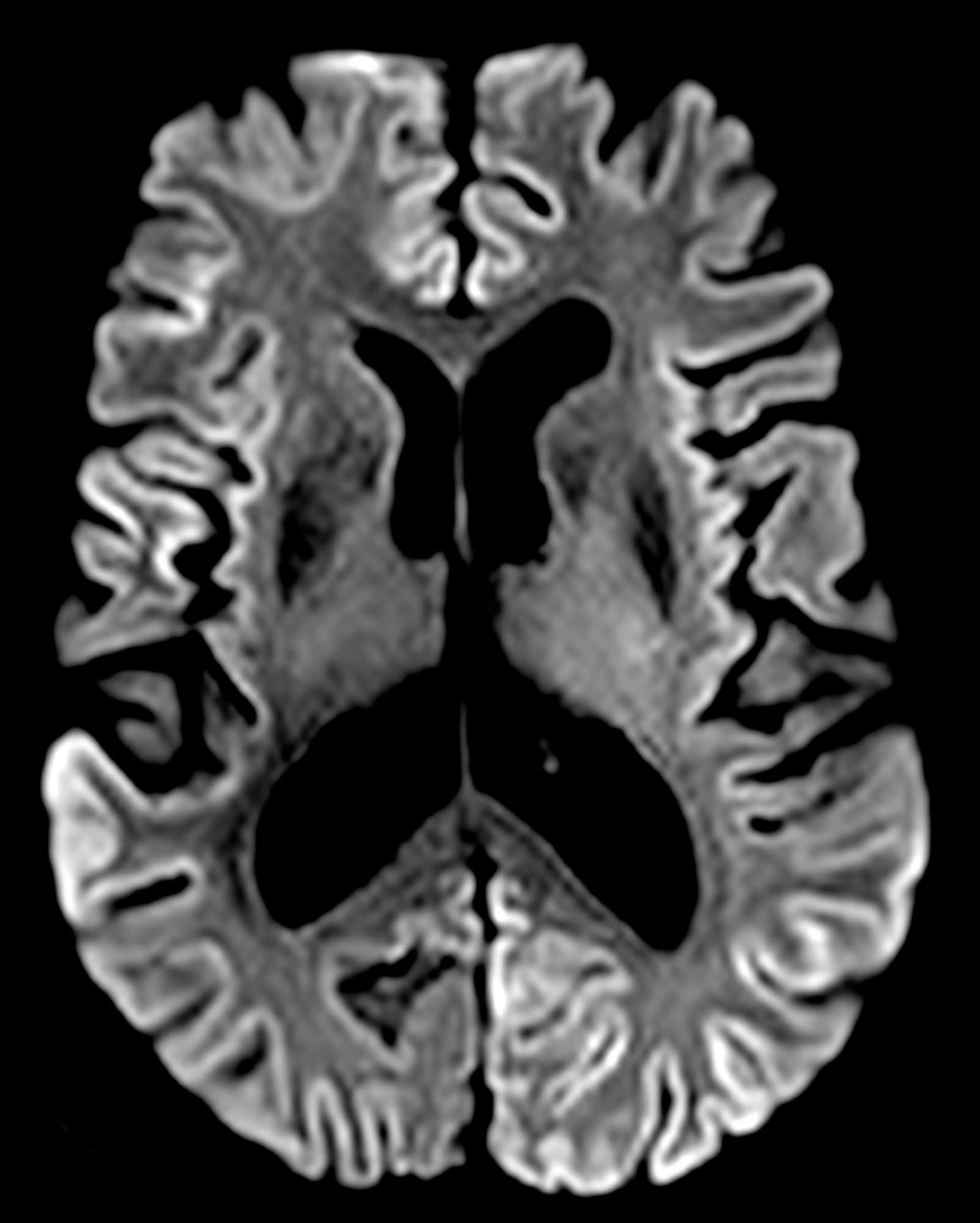 Creutzfeldt-Jakob Disease (Brain MRI)