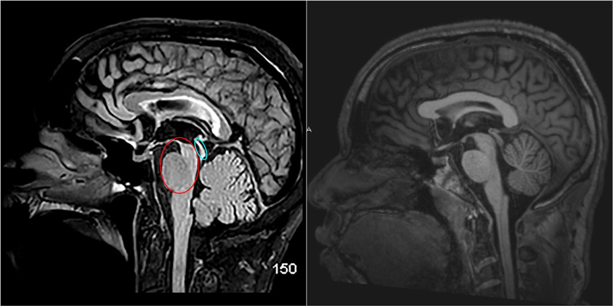 进行性核上性麻痹（MRI）
