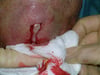 Purulent Discharge