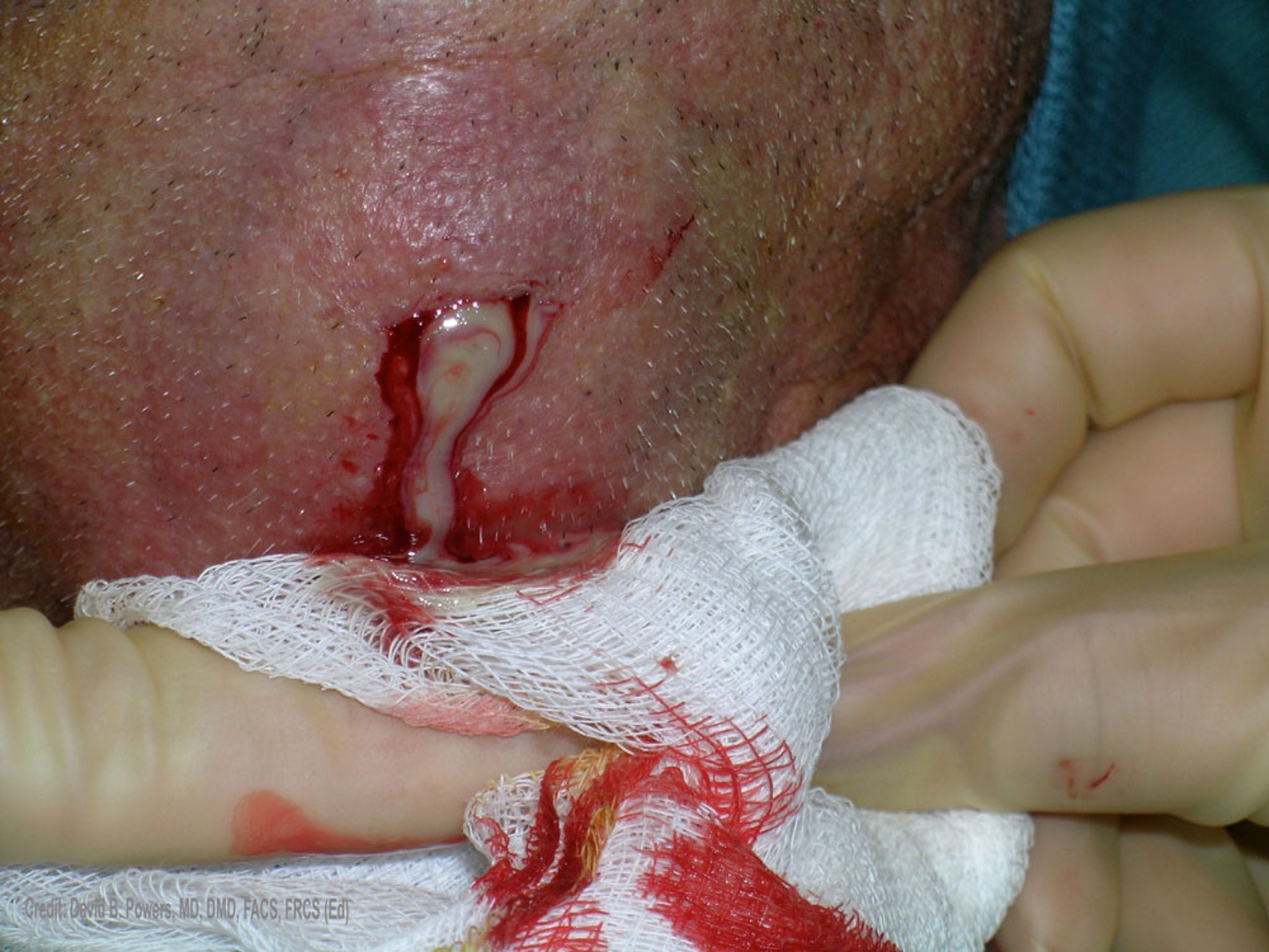 Secreção purulenta