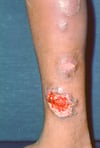 Pyoderma gangraenosum (ulzerativer klassischer Subtyp)