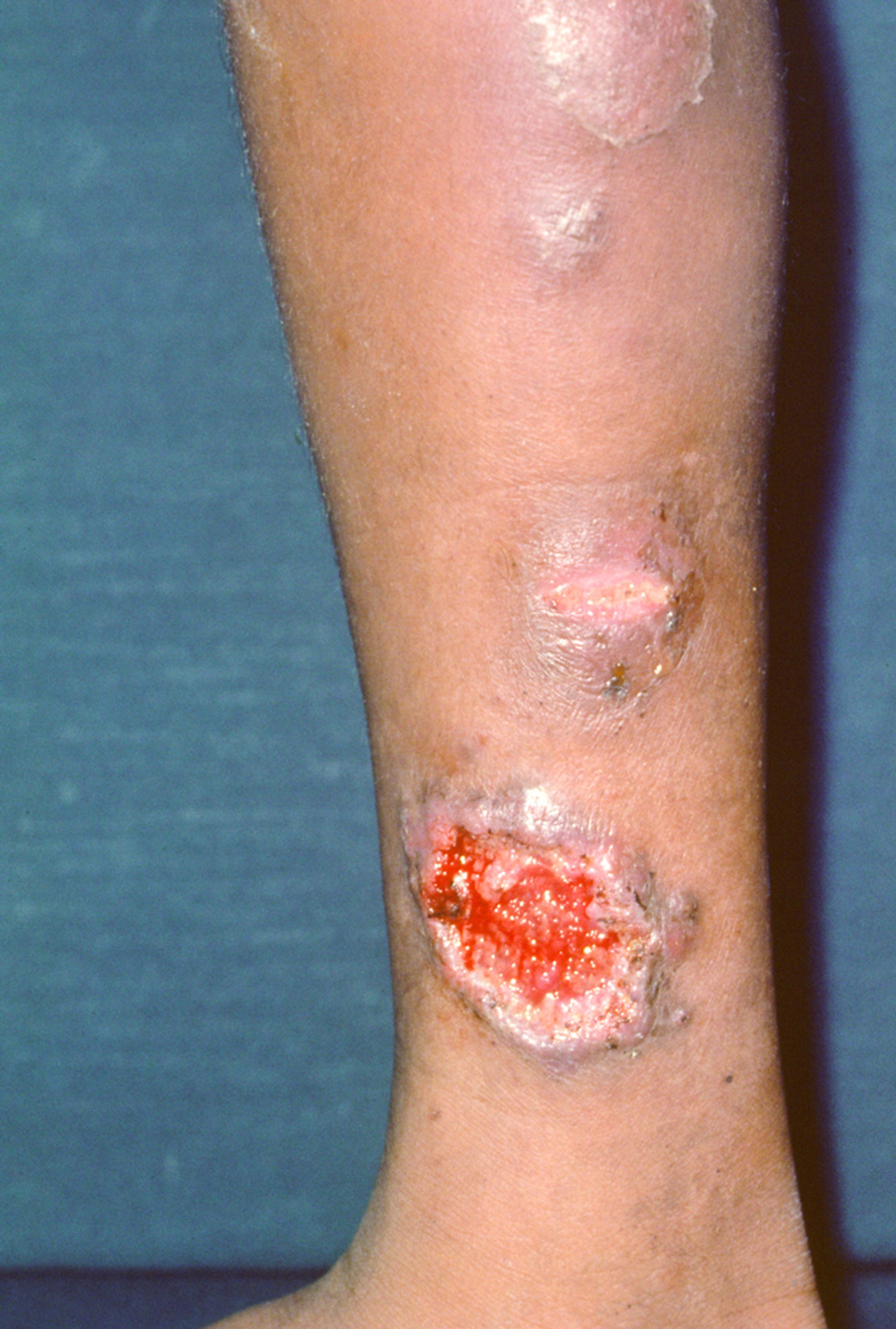 Pyoderma gangrenosum ulcéreux (classique)