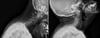 Atteinte du rachis cervical dans la polyarthrite rhumatoïde