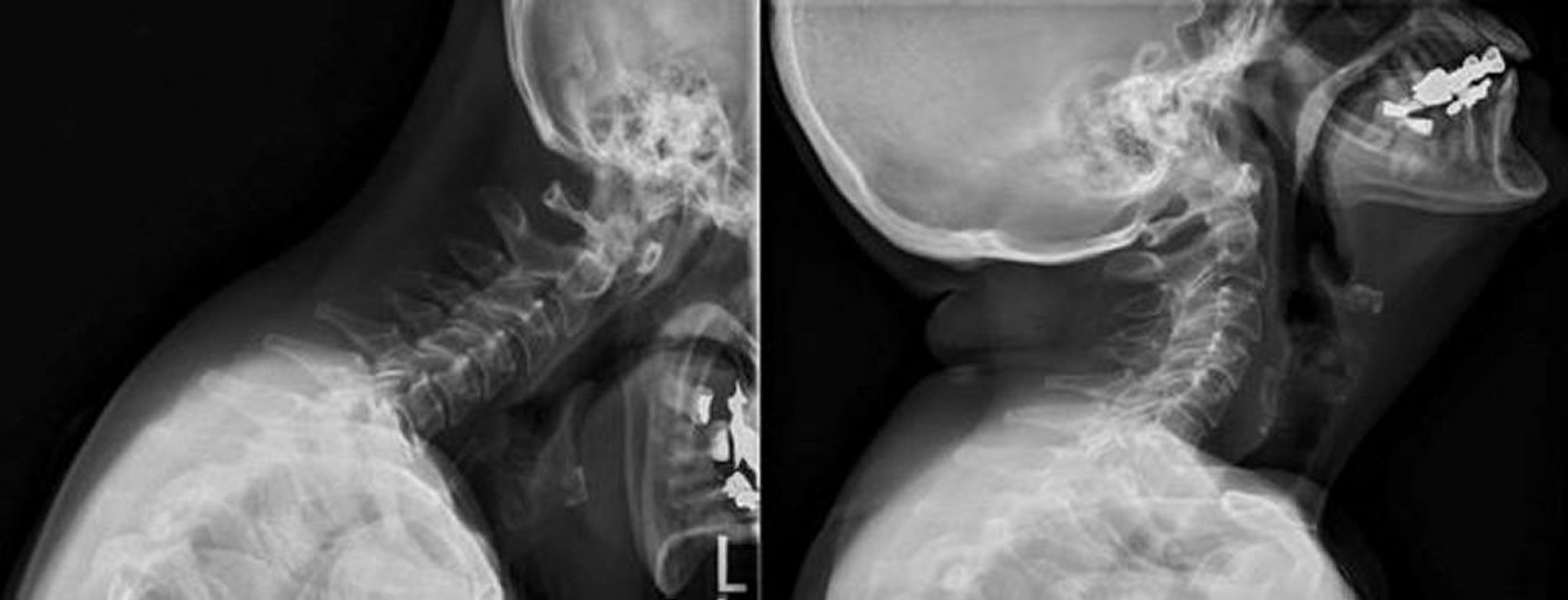 Atteinte du rachis cervical dans la polyarthrite rhumatoïde