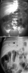 Caractéristiques radiologiques de l'entérocolite nécrosante
