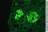 Enfermedad por anticuerpos contra la membrana basal glomerular
