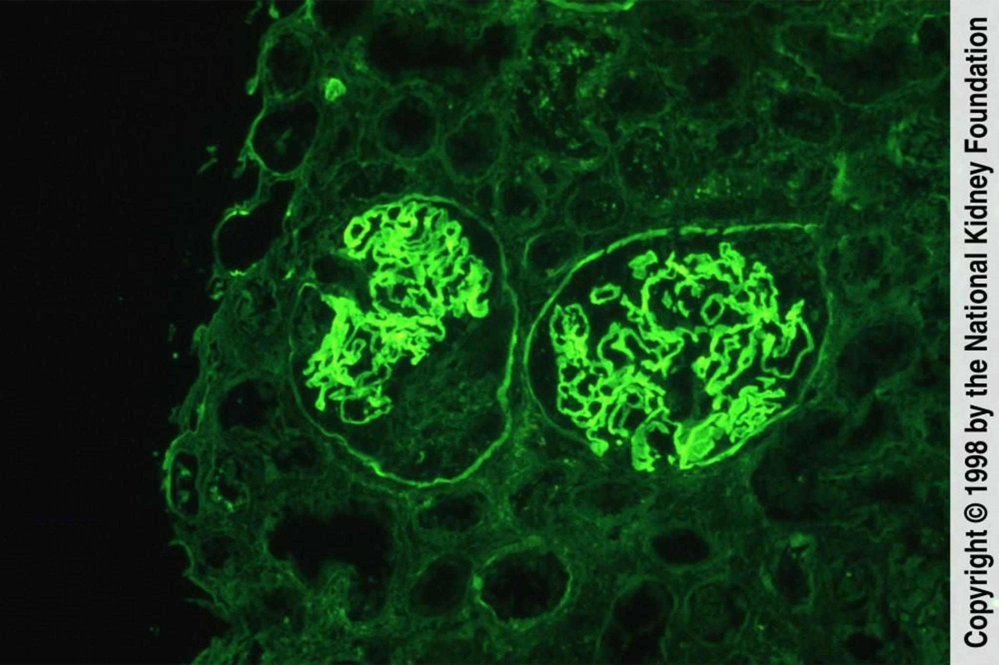 Enfermedad por anticuerpos contra la membrana basal glomerular