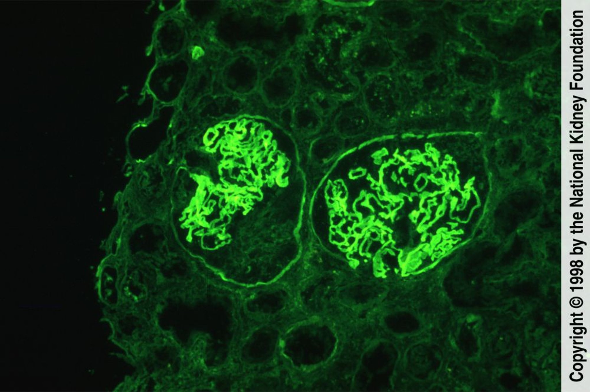 Болезнь с образованием антител к базальной мембране клубочков (болезнь анти-БМК-антител)