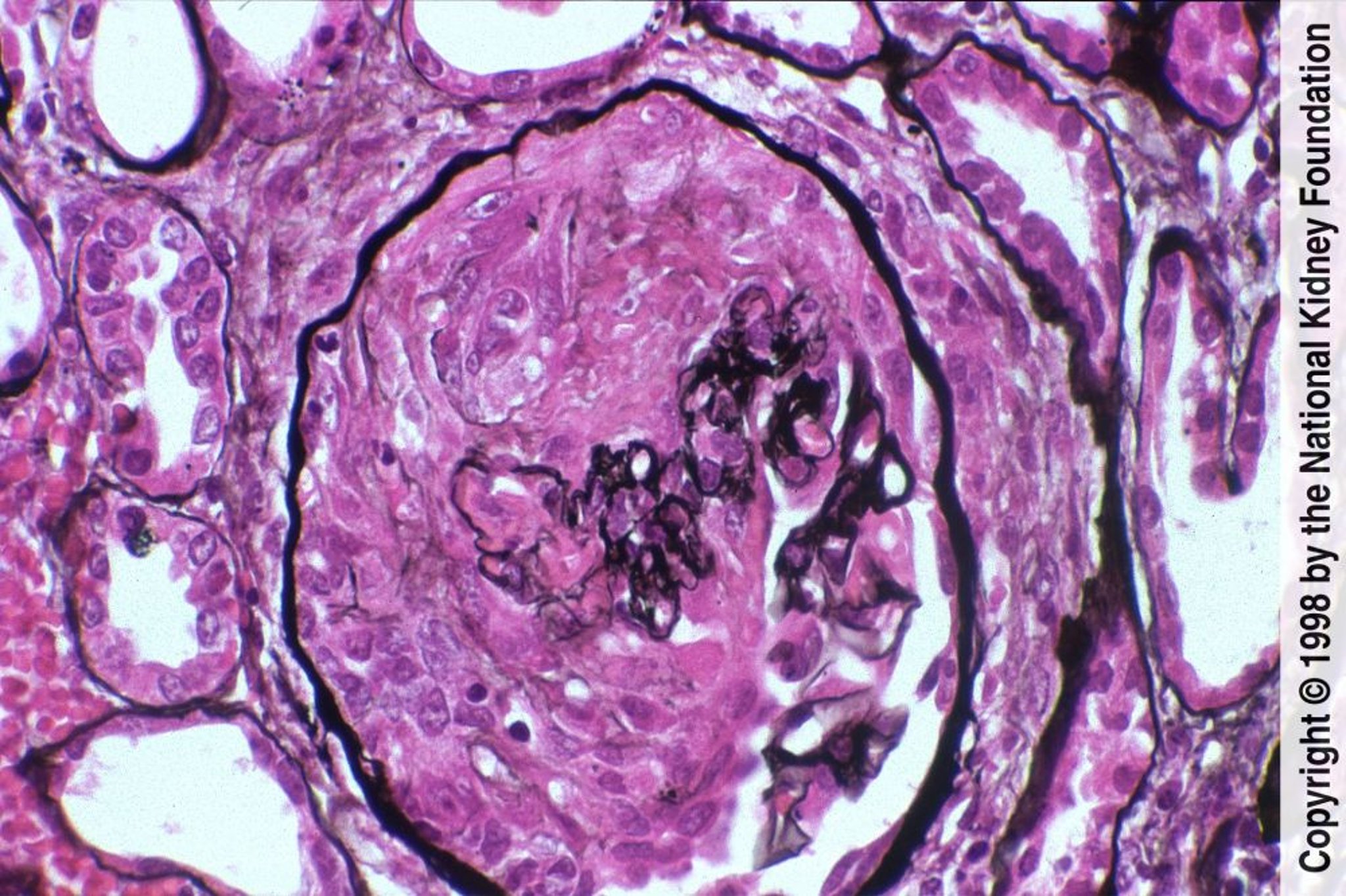 Glomerulonefritis de progresión rápida (Pauci-inmune)