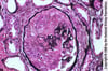 Glomérulonéphrite rapidement progressive (Pauci-Immune)