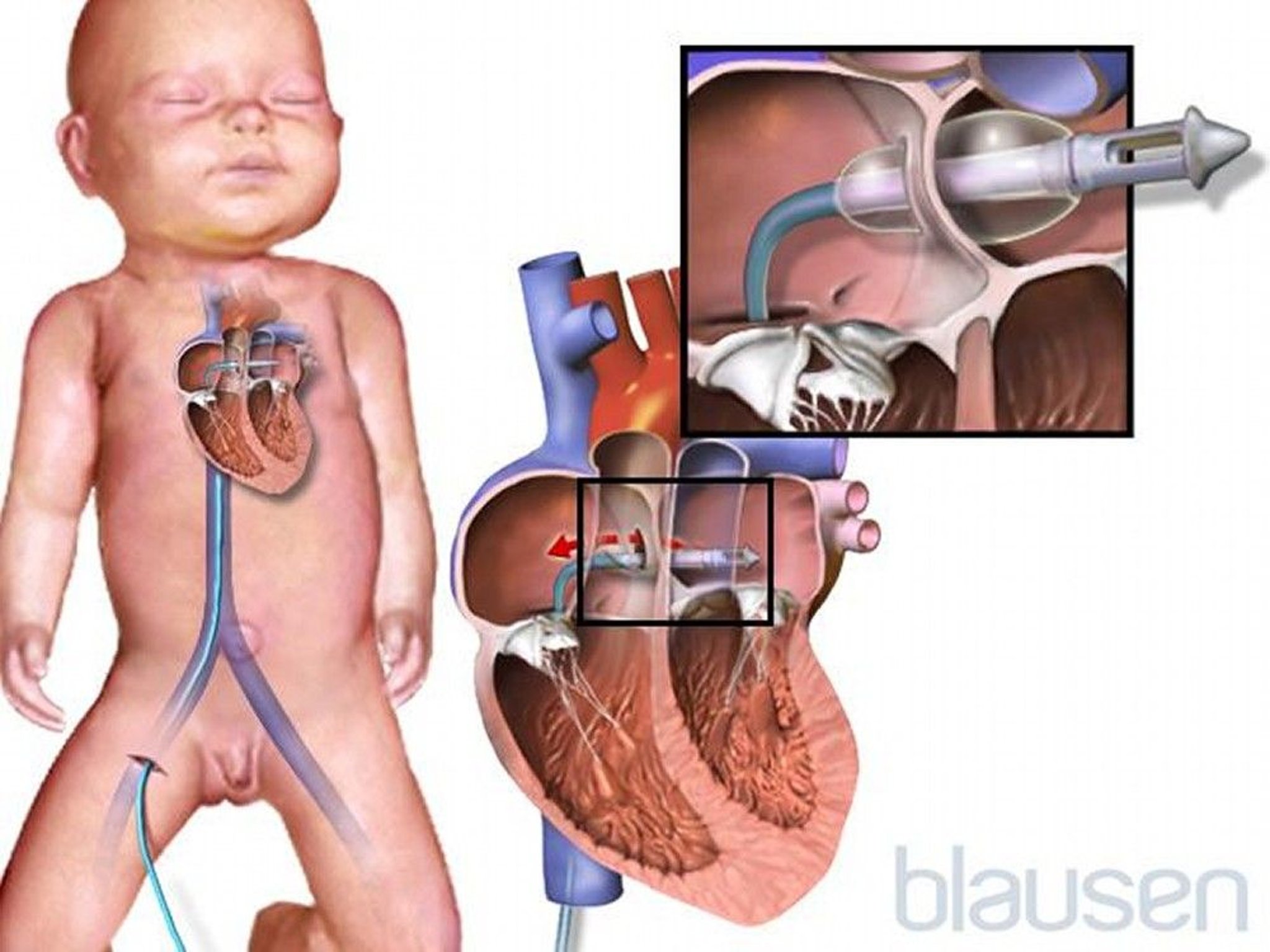 Balloon Atrial Septostomy (Rashkind Procedure)