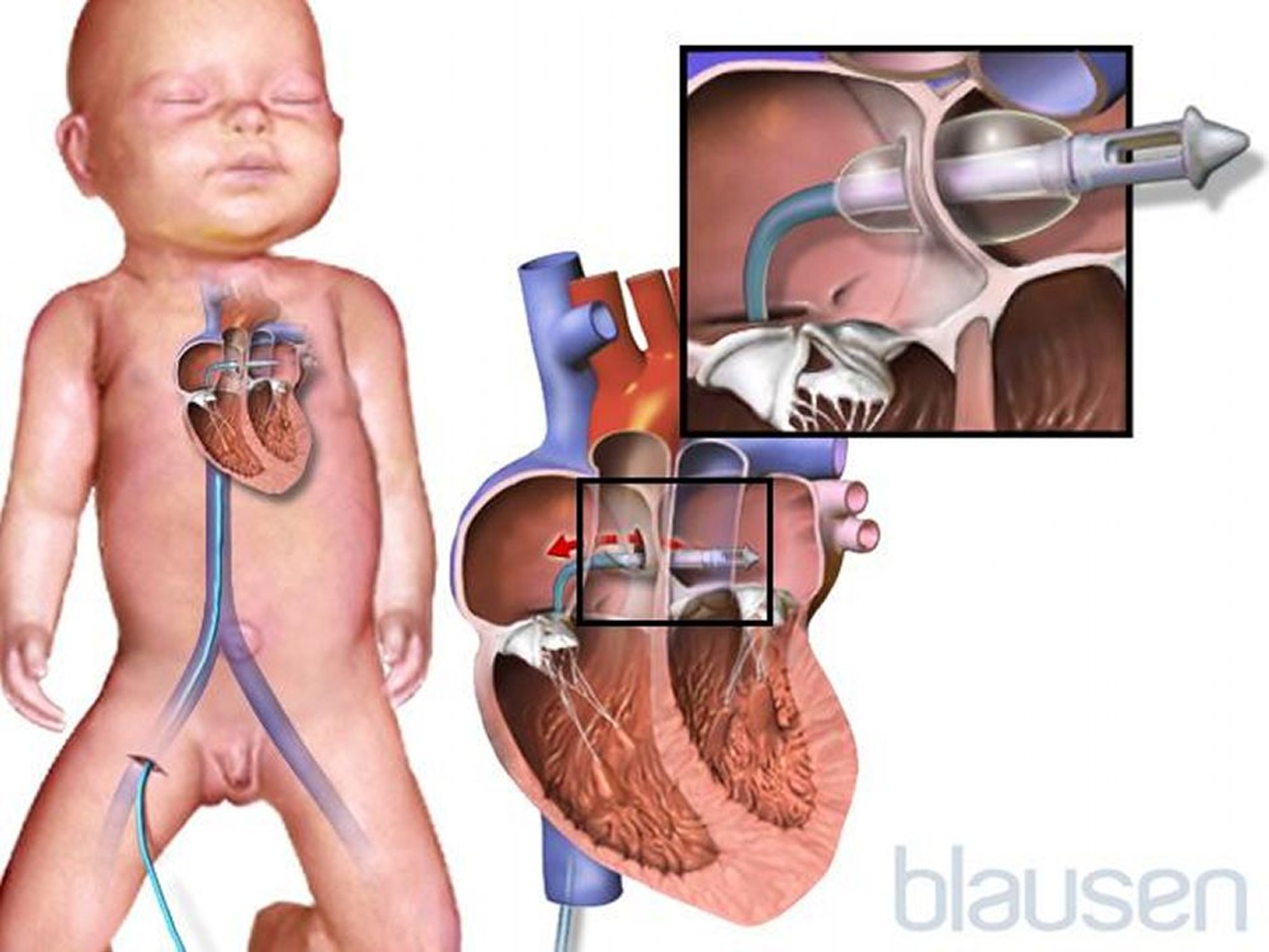 Septostomia atrial por balão (procedimento de Rashkind)