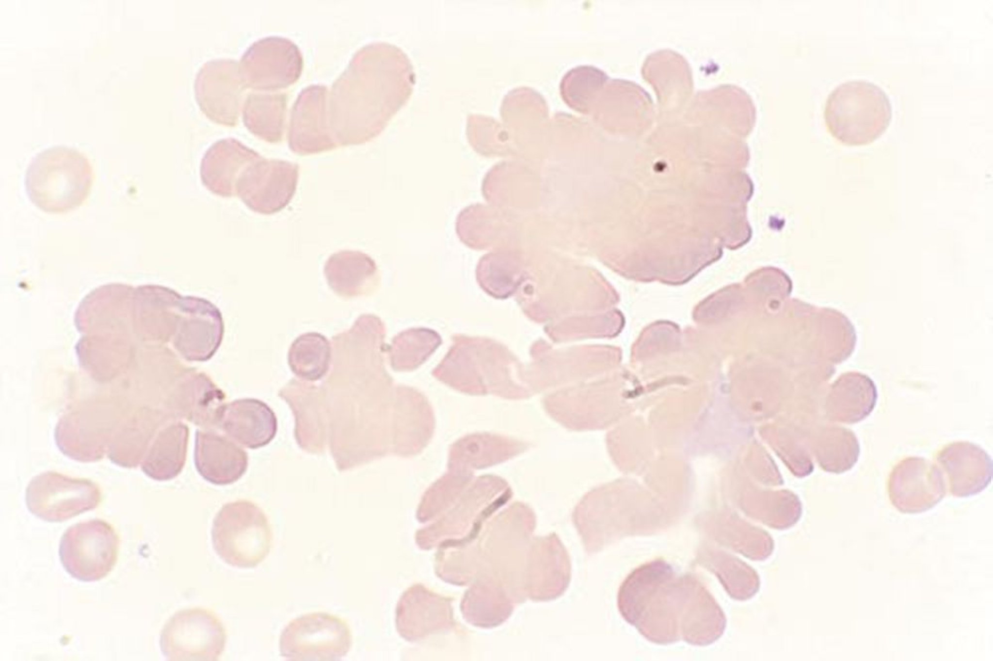 Condensación de eritrocitos en la enfermedad por crioaglutininas