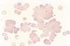 Agglutination des globules rouges dans la maladie des agglutinines froides