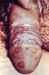 Balanitis en la artritis reactiva por Chlamydia