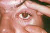 Conjuntivitis en la artritis reactiva por Chlamydia