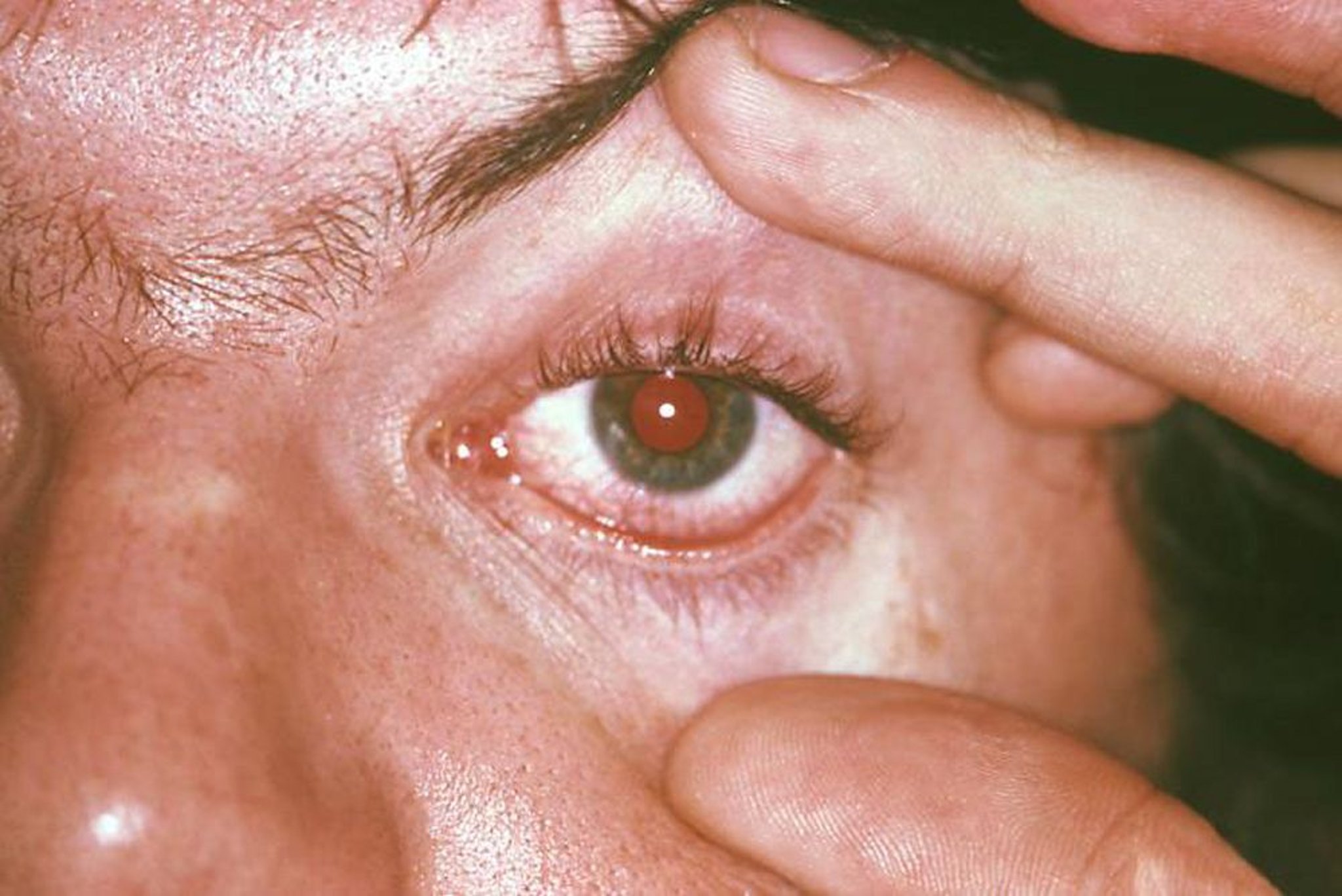 Conjunctivitis in Chlamydial Reactive Arthritis
