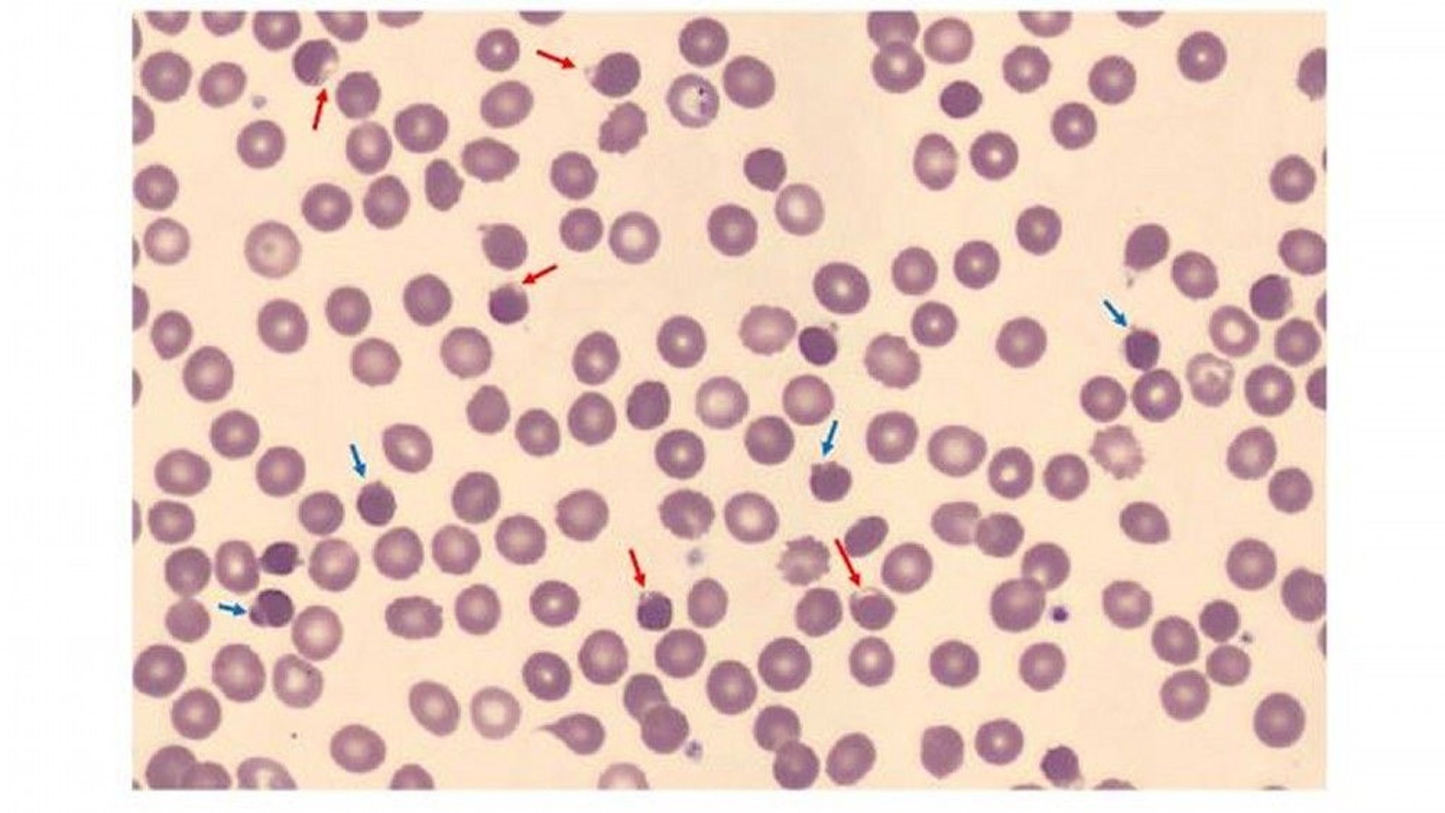 Hereditary Erythrocyte G6PD Deficiency