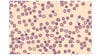 Deficiencia hereditaria de eritrocitos G6PD