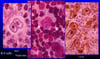 Reed-Sternberg Cell
