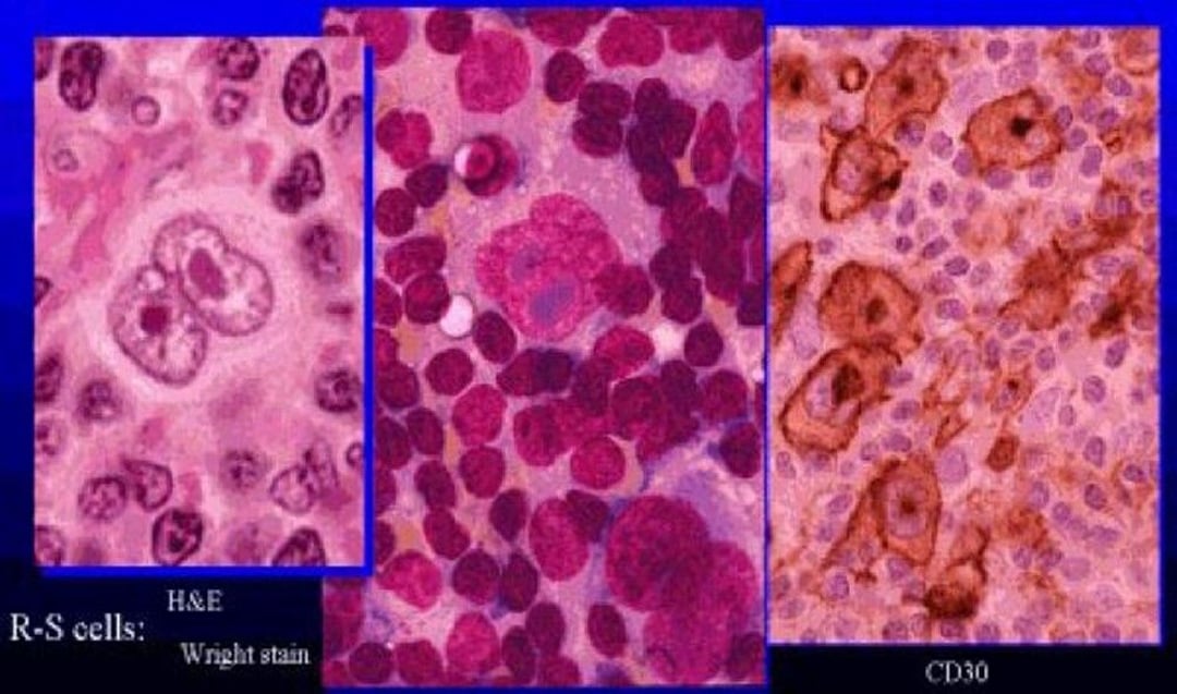 Hodgkin Lymphoma - Oncology - Merck Manual Professional Edition