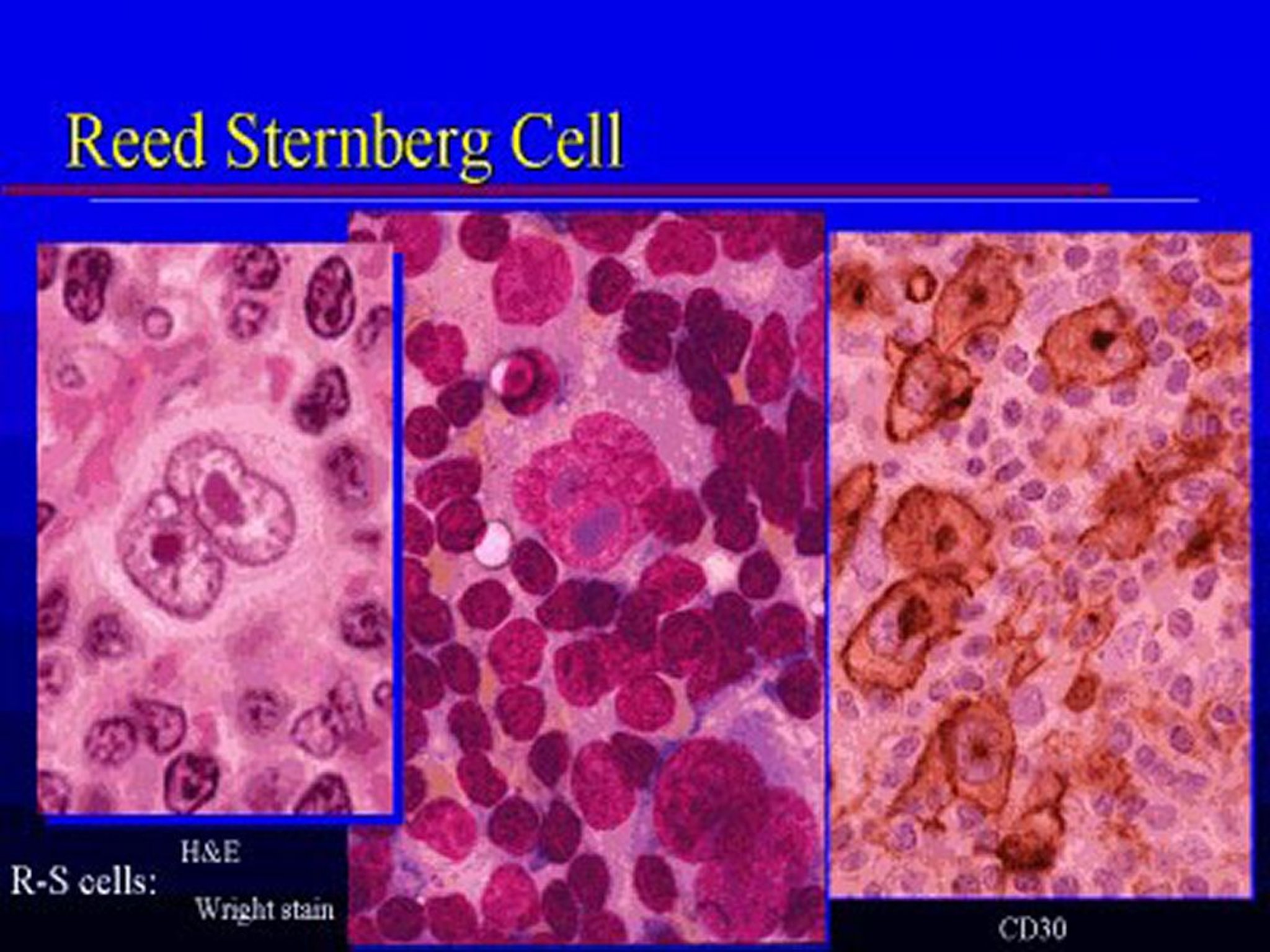 Cellula di Reed-Sternberg