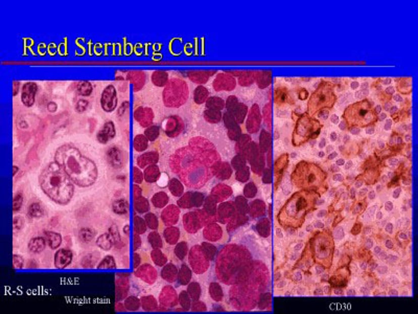 リード-ステルンベルグ細胞