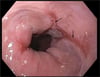 Reflux Esophagitis