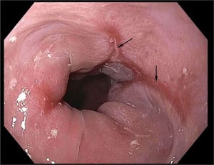 Refluxösophagitis