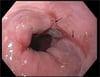 Œsophagite par reflux