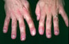 Reactive Arthritis (Nails)
