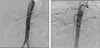 Renal Artery Stenosis (Digital Subtraction Angiography)