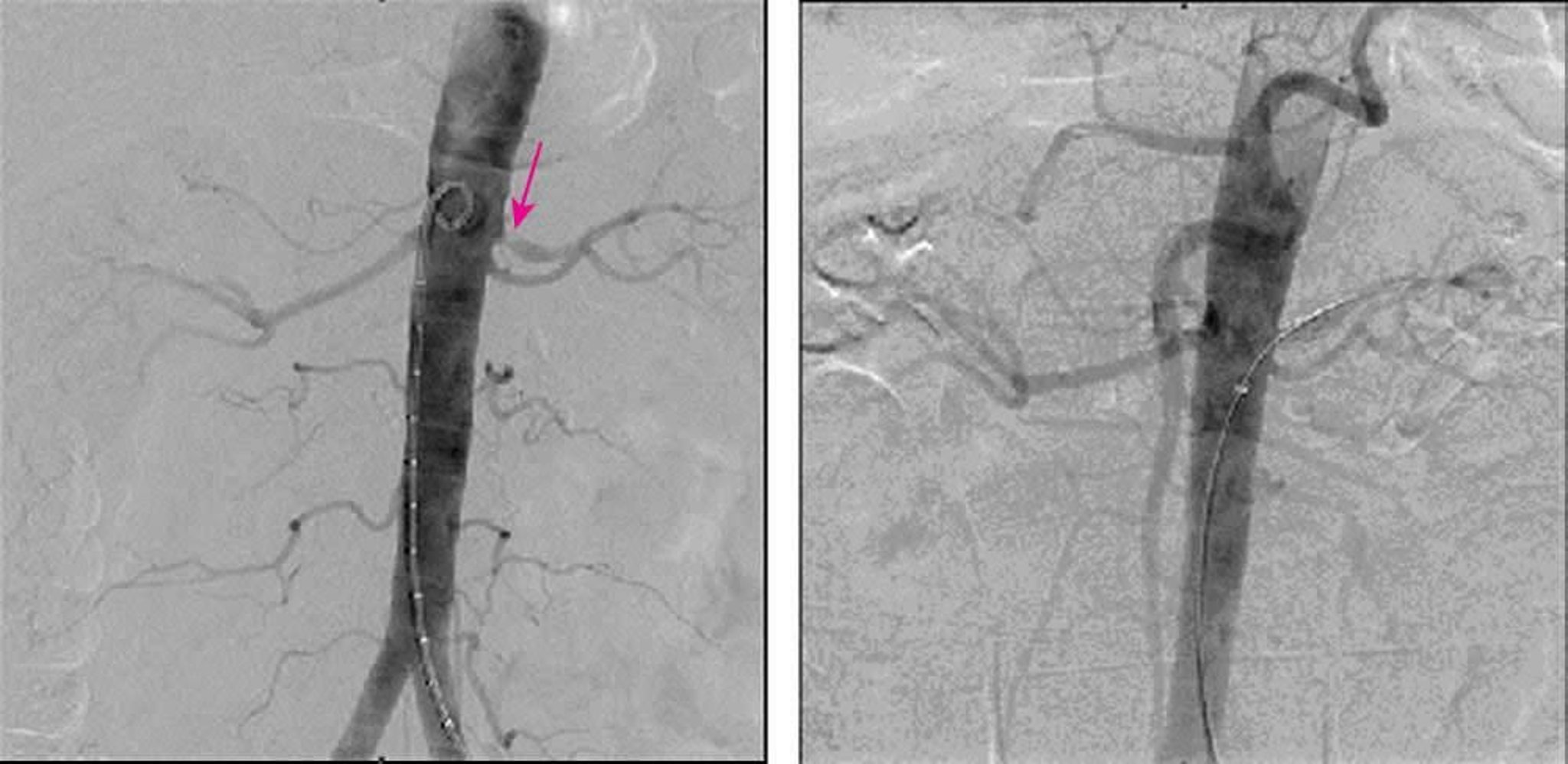 Estenosis de la arteria renal (angiografía por sustracción digital)