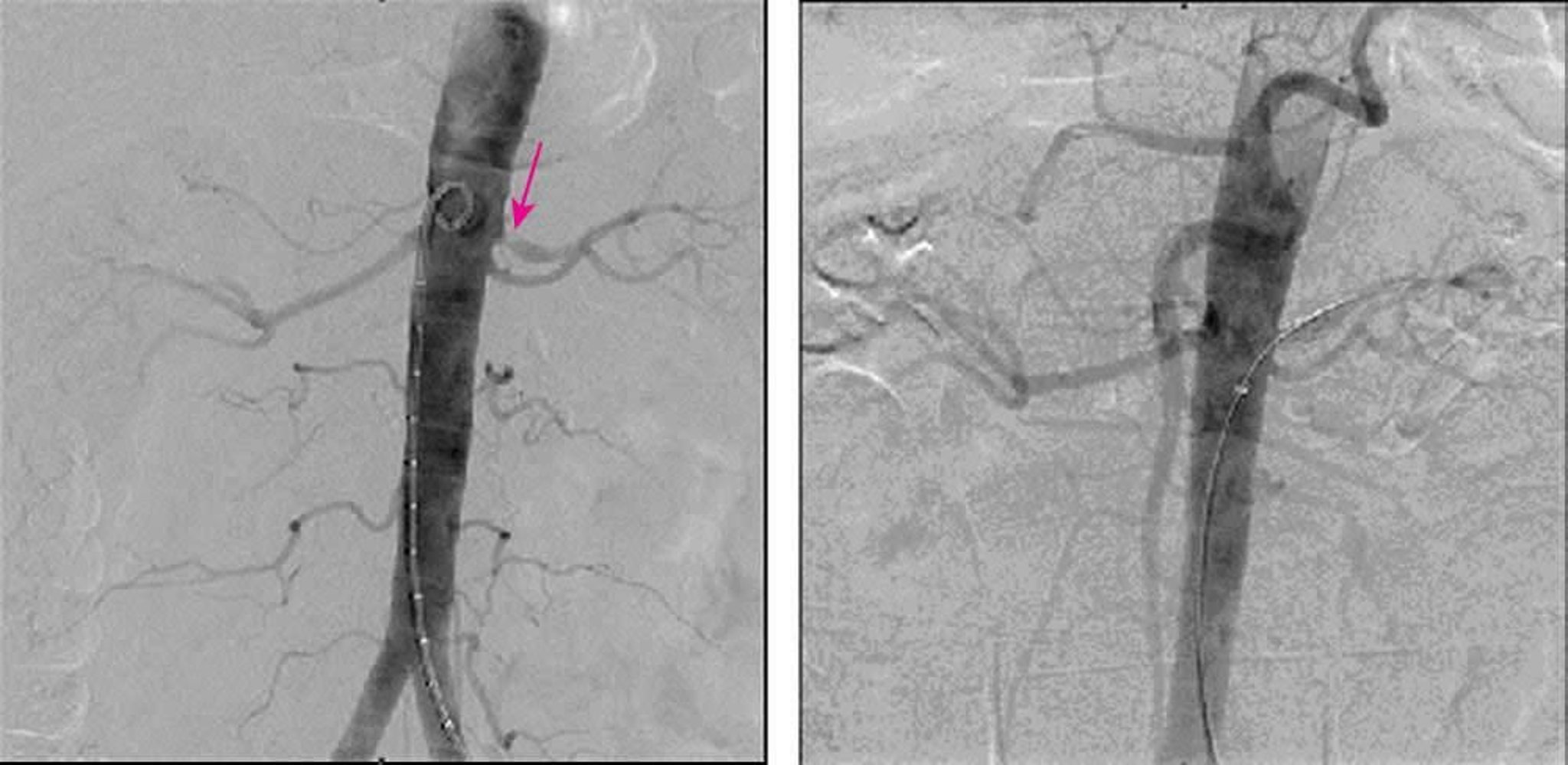 Estenose arterial renal (angiografia digital por subtração)