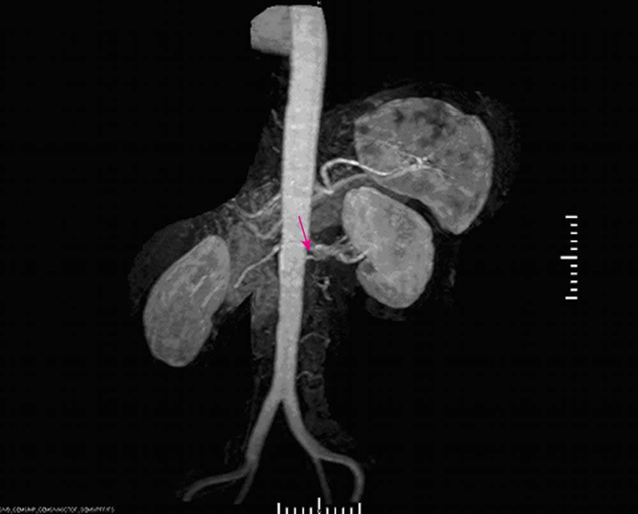 Hypertension rénovasculaire (angiographie par résonance magnétique)