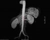 Hipertensão renovascular (angiografia por ressonância magnética)