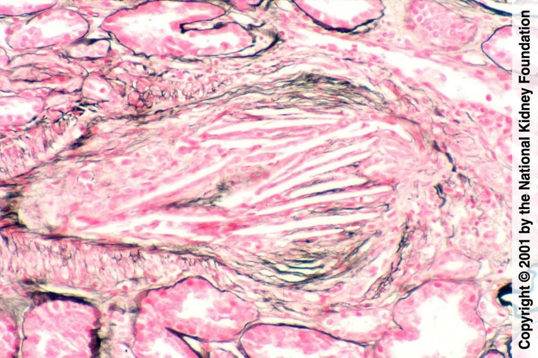 Renal Atheroembolism