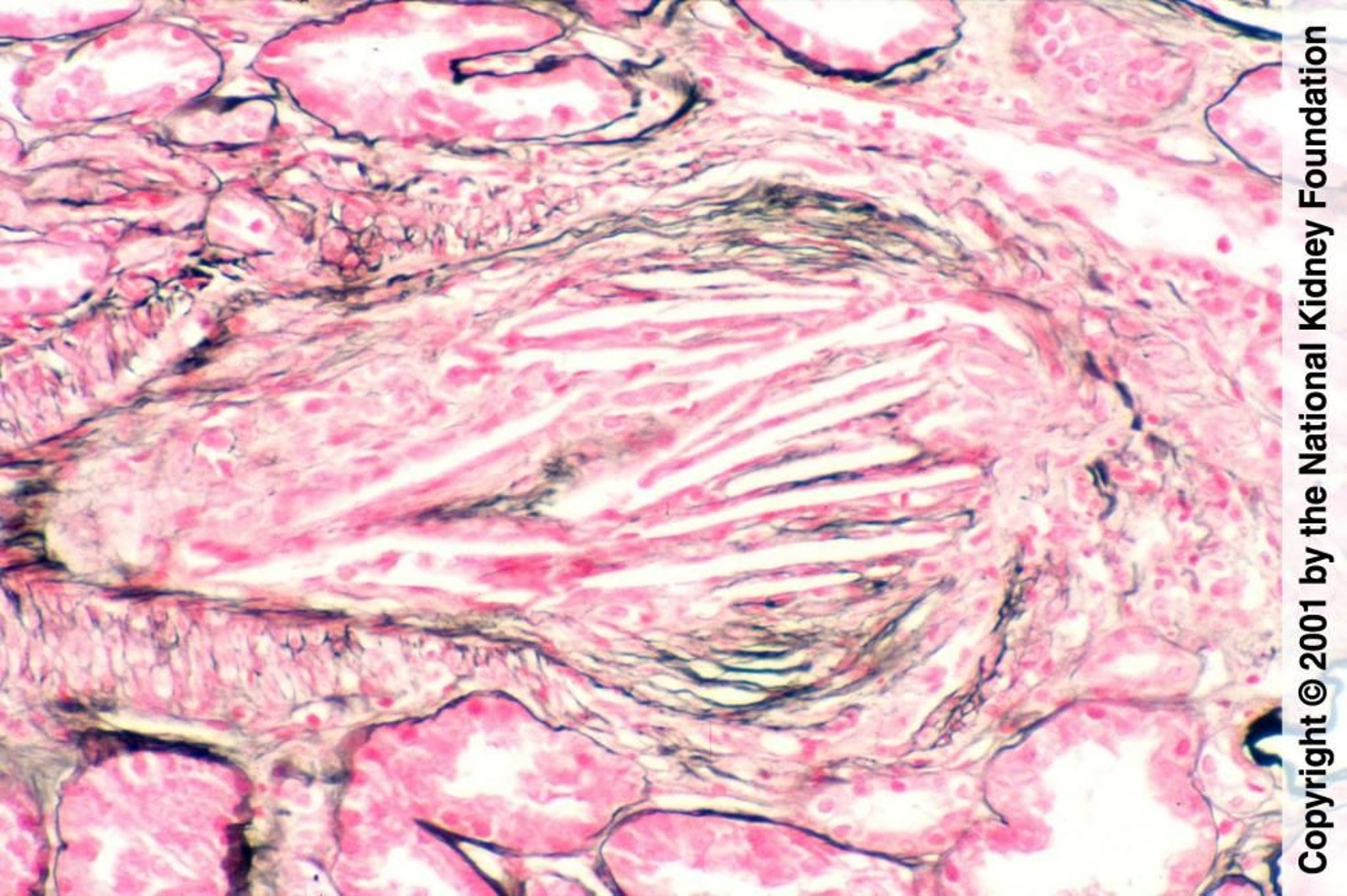 Ateroembolismo renal