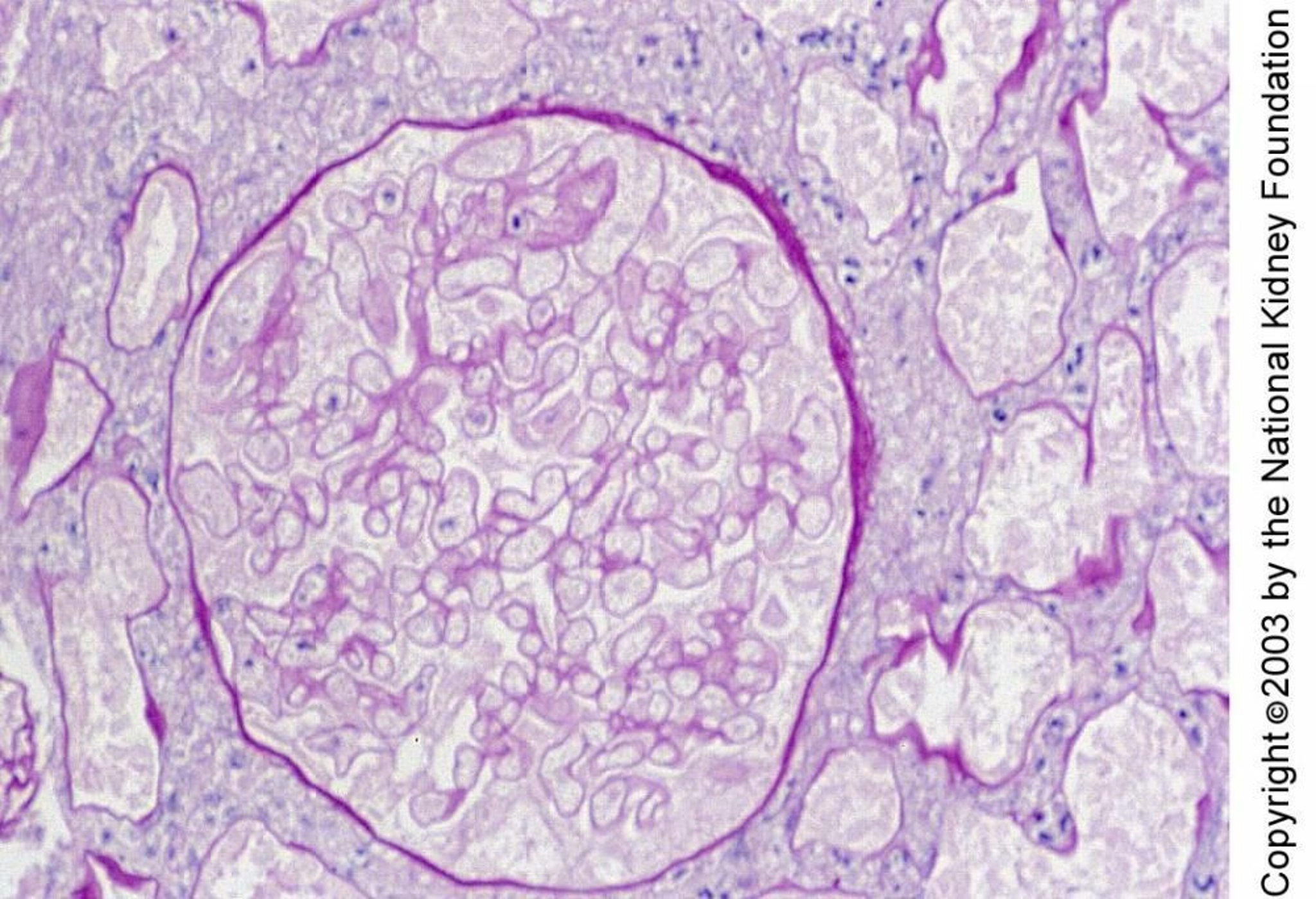 Necrosi corticale renale