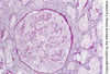 Necrose cortical renal
