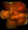 Retinitis (HSV)